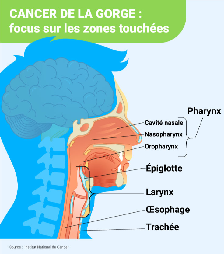 Cancer de la gorge les zones touchées : le pharynx, cavité nasale, nasopharynx, oropharynx, épiglotte, larynx, œsophage, trachée